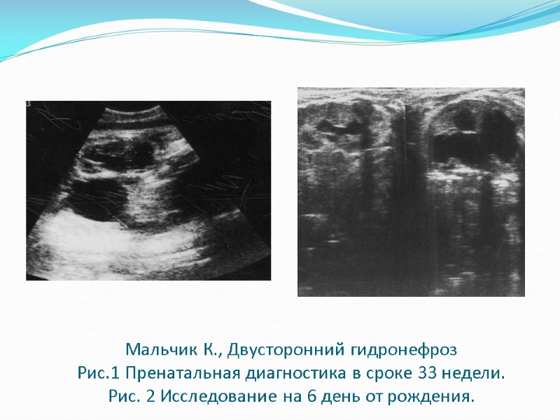 Мальчик К., Двусторонний гидронефроз  Рис.1 Пренатальная диагностика в сроке 33 недели. Рис. 2